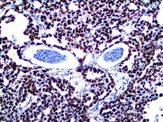 IHC of SALL4 on an FFPE Testicular Cancer Metastasis to Liver Tissue